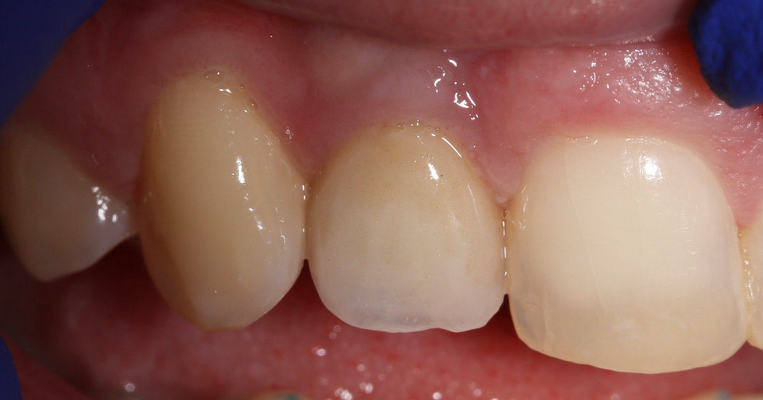 Tooth replaced by implant with bone/gum grafting